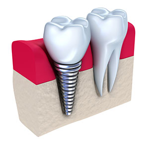 Tooth replacement with an implant