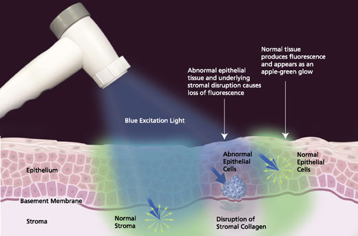 VELscope for oral cancer screening