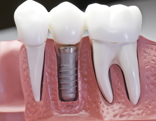 Dental Implants (Placement and Restoration)