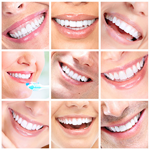 Porcelain Veneers, cosmetic dentistry