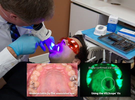 Oral Cancer Screening